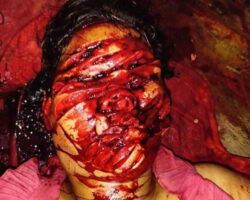 Woman chopped her niece’s face with an axe