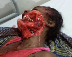 Colombian woman after brutal machete attack by her boyfriend
