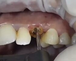 Extraction of decayed tooth