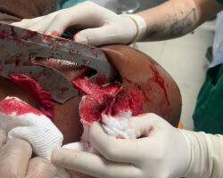 Guy arrived at hospital with sword stuck in his shoulder