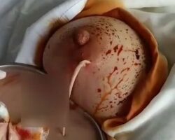 Breast infection after augmentation