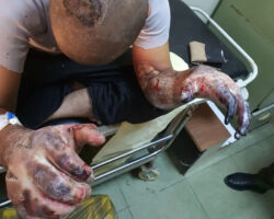 Brutal signs of torture on man detained by Iraqi police