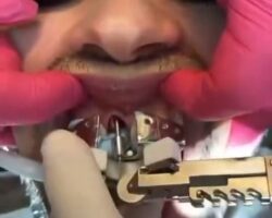 Complicated tooth extraction