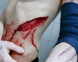 Deep cut on ribs of anorexic woman