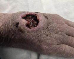 Deep wound on hand of old female patient