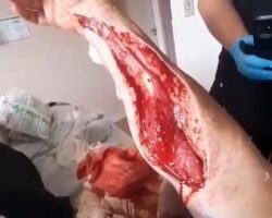 Guy came to hospital with open injury on his arm