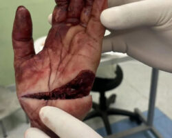 Hand cut up in workplace accident