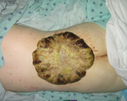 Huge tumor on patient's back