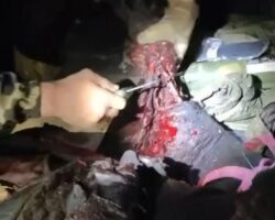 Improvised amputation of Russian soldier’s arm