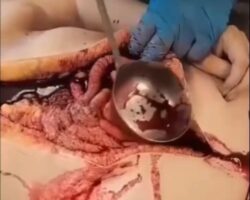 Improvised drainage of fluid from abdominal cavity