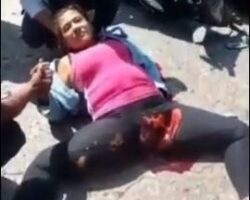 Motorcycle accident almost tore her leg off