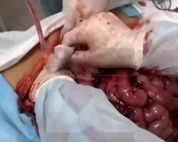 Parasite discovered in abdominal cavity of soldier during surgery