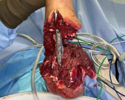 Reconnection of nerves and tendons in the patient's arm