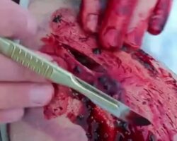 Russian climber performs self-surgery on mountainside