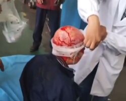 Scalped woman after work accident