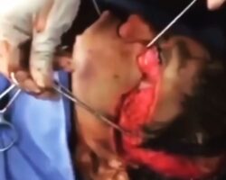 Serious injury requires complete facial reconstruction
