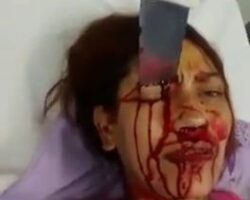 Woman has kitchen knife stuck in her face