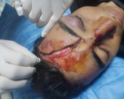 Collision of two motorcycles caused him head injury