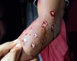 Consequences of shotgun blast