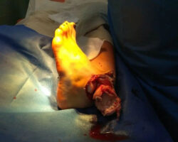 Drunk woman caused herself open ankle fracture