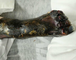 Elderly woman was fused to wheelchair for 8 days