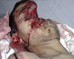 Fractured skull as result of traffic accident