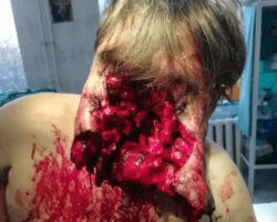 Guy survived suicide attempt with shotgun