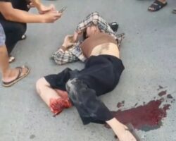 Her foot is almost torn off after traffic accident