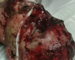 Hospitalized Russian soldier with exposed brain