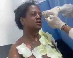 Hospitalized woman after being set on fire by her boyfriend