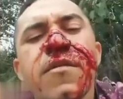Motorcyclist cut his face open on barbed wire