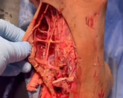 Open foot wound sustained in traffic accident