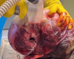 Opening of skull during forensic autopsy
