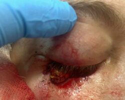 Splinter impaled eye, almost hitting brain