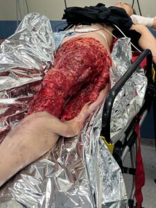 Young woman suffered serious leg injury while getting off bus