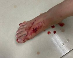 Boy attacked and bitten by stray dog