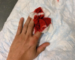 Dude cut off tip of his finger with sliding door