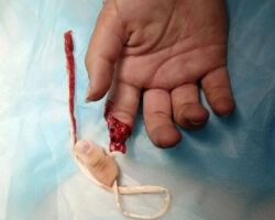 Girl tore off her finger while climbing over fence