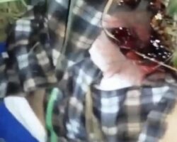 Man lost his penis in motorcycle accident