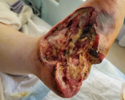 Minor foot injury led to amputation