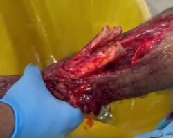 Open leg fracture caused by traffic accident
