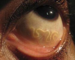 Parasite in eye after mosquito bite