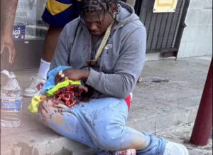 Rapper 4Xtra blew up his hand with fireworks