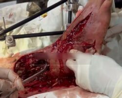Russian soldier hospitalized due to leg war injury