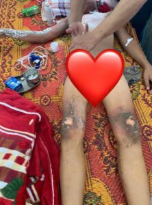 Two students electrocuted while trying to take down kite from power lines