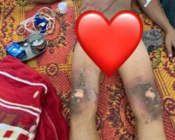 Two students electrocuted while trying to take down kite from power lines