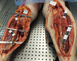 Woman suddenly died of cardiac arrest caused by venous thrombosis