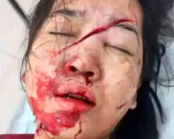 Young Vietnamese woman slashed in face with sickle