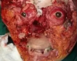 Breathtaking facial reconstruction of woman after car accident