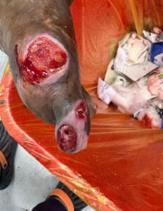 Cleaning diabetic patient’s foot wound